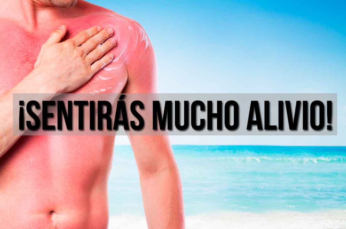 ¿Te bronceaste de más? No te preocupes aquí tenemos algunos remedios para aliviar las quemaduras de sol. Procura no quemarte constantemente.