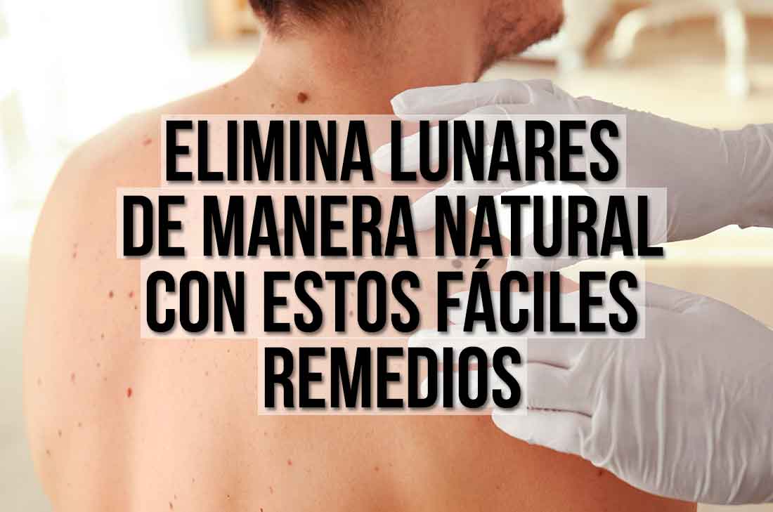 Remedios caseros para eliminar lunares de forma natural