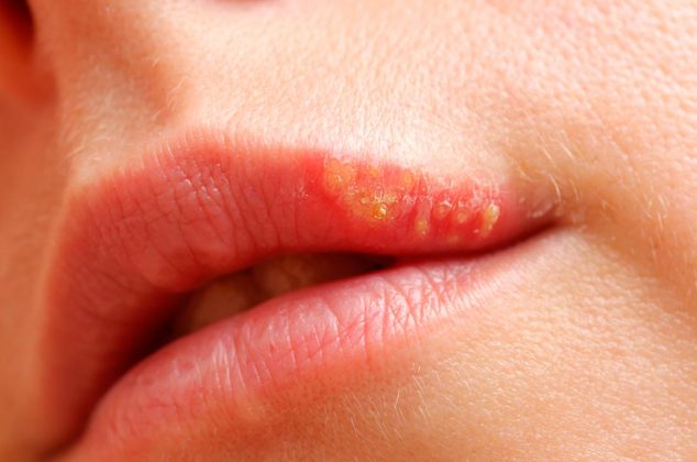 Cómo eliminar un fuego labial o herpes labial fácilmente 0