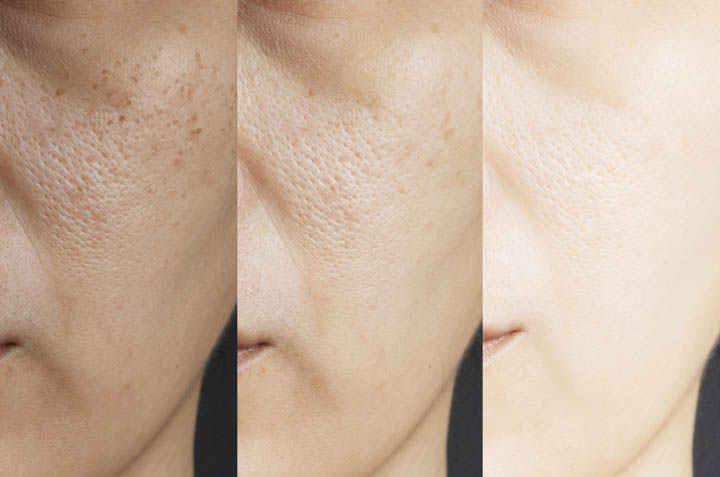 Mascarilla de bicarbonato