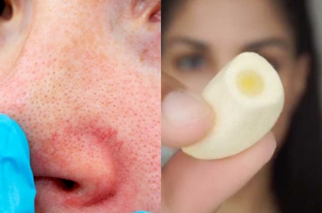 Cómo eliminar esas feas venitas rojas de la cara con remedios caseros