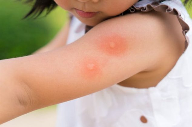 13 remedios caseros para aliviar la picadura de mosquitos, hormigas y arañas