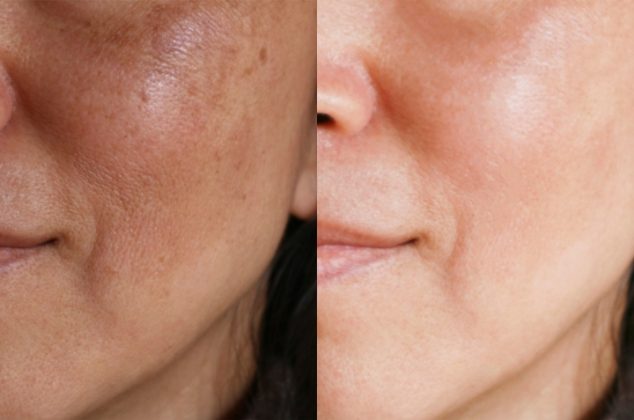 Mascarilla para quitar paño de la cara y recuperar tu piel sin imperfecciones