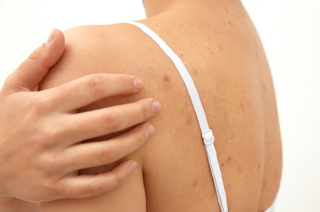 3 formas de eliminar el acné de la espalda con remedios 100% naturales