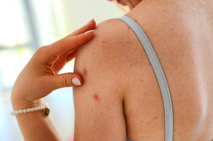 3 formas de eliminar el acné de la espalda con remedios 100% naturales 0