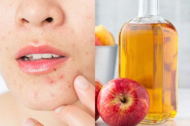 Cómo usar vinagre de manzana para quitar el acné y las manchas en la piel