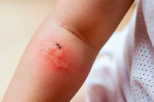 El mejor remedio para quitar la comezón de la picadura de mosquito