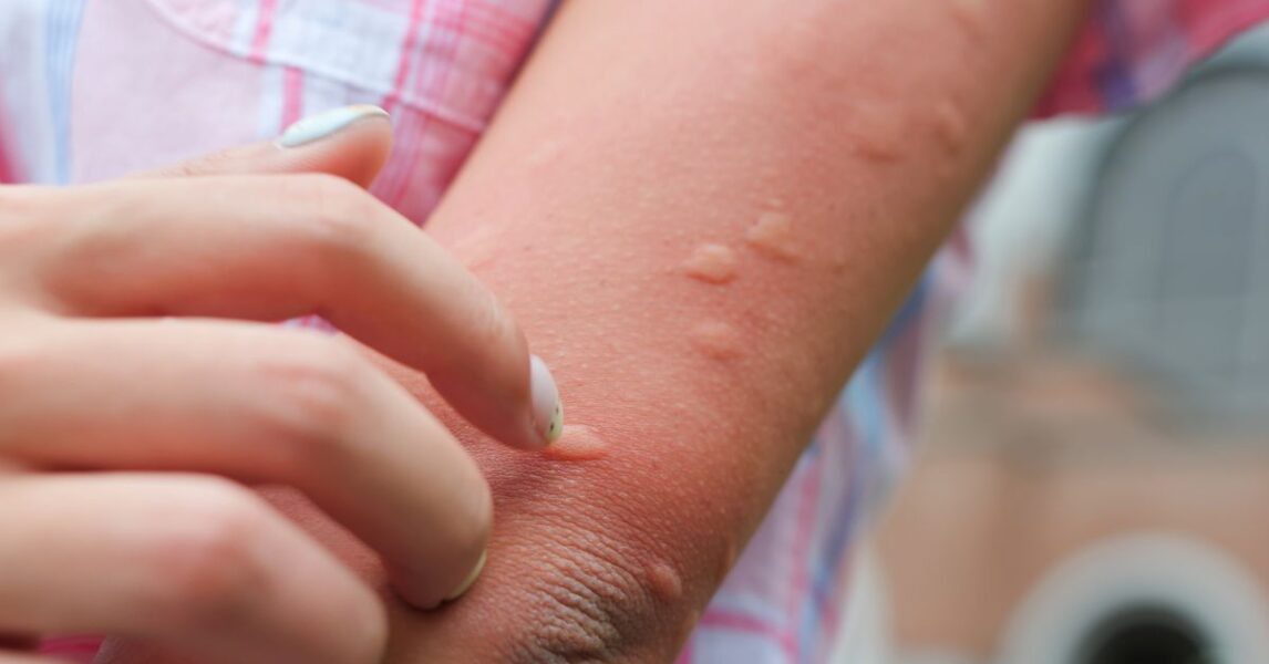 quitar la comezón de la picadura de mosquito