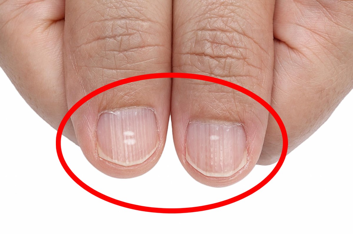 líneas blancas en las uñas