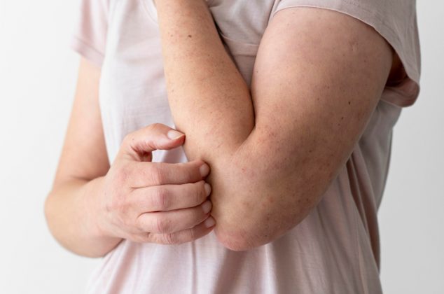 Tips para eliminar los granitos blancos en los brazos de forma natural