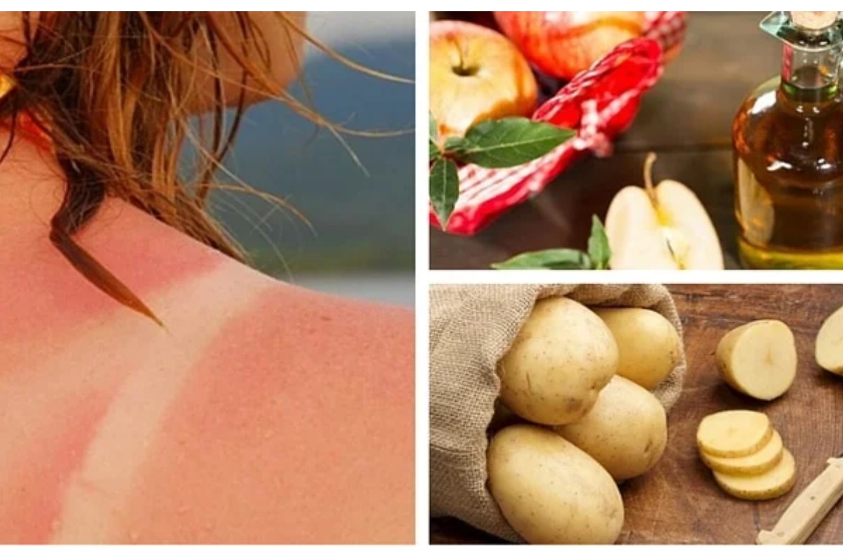 7 remedios caseros para aliviar las quemaduras de sol