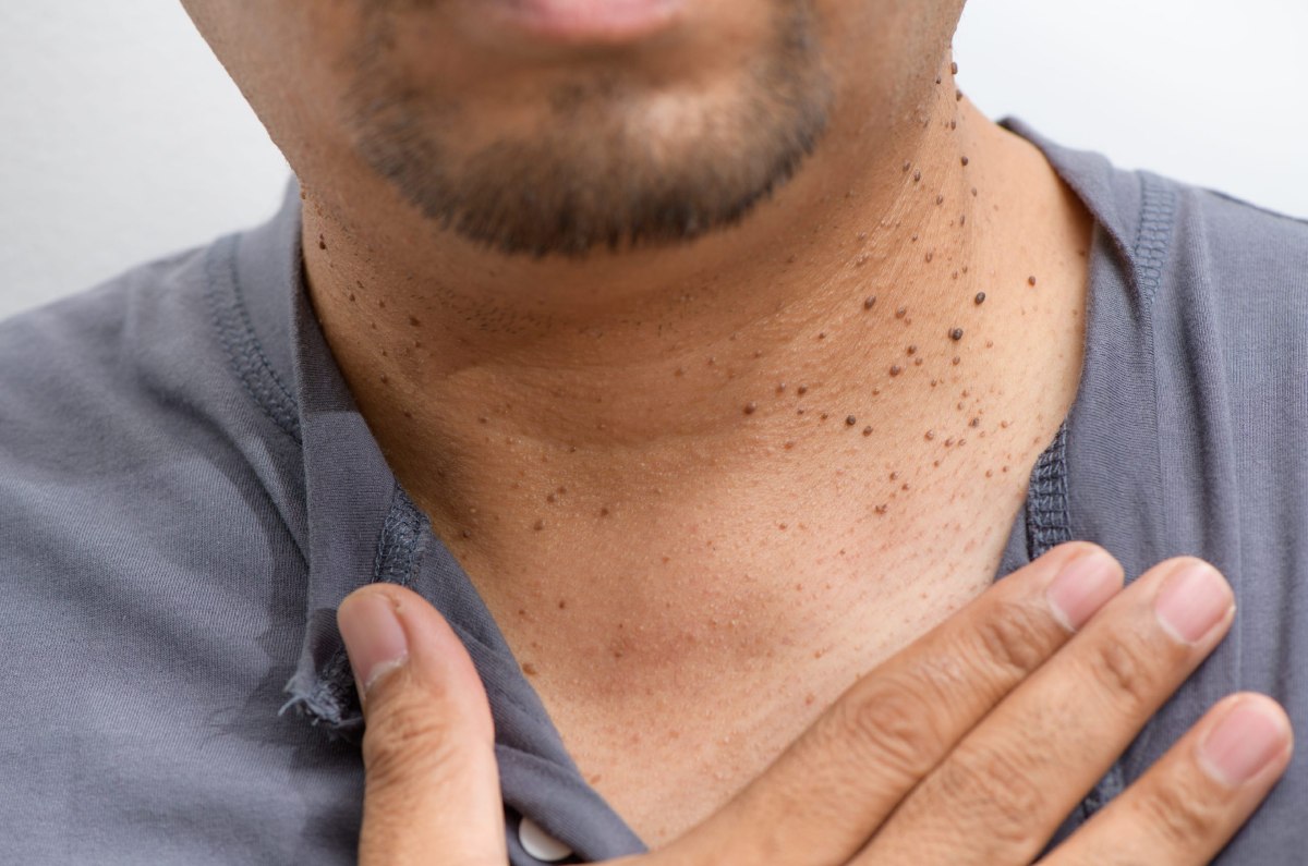 como eliminar verrugas del cuello