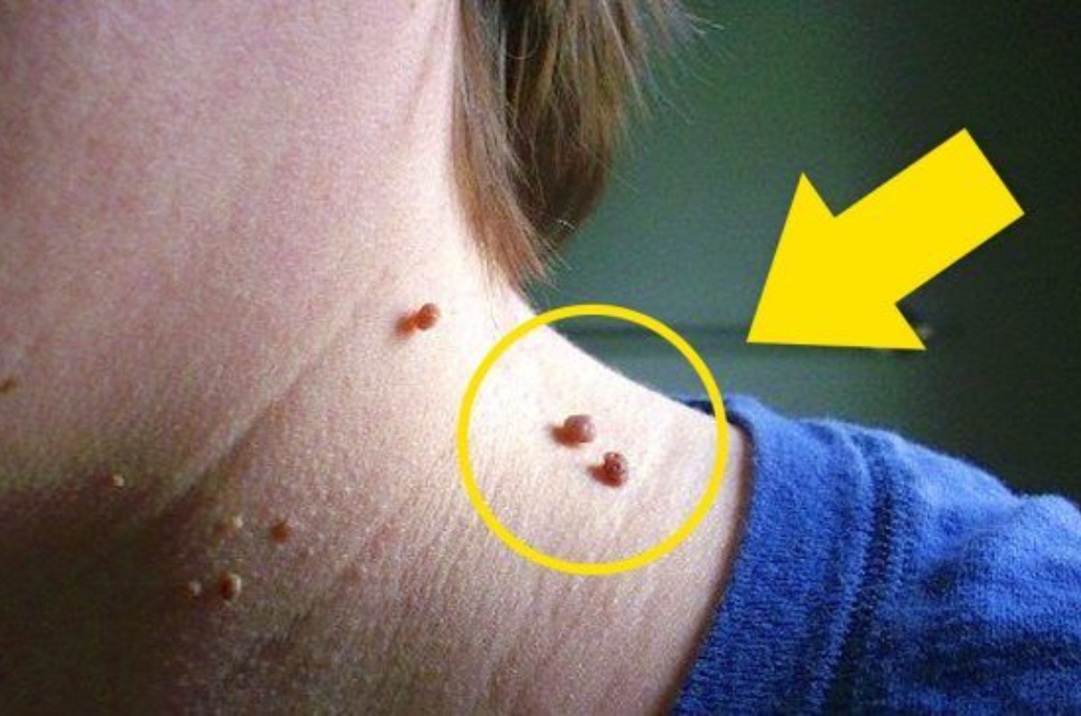 cómo eliminar verrugas del cuello