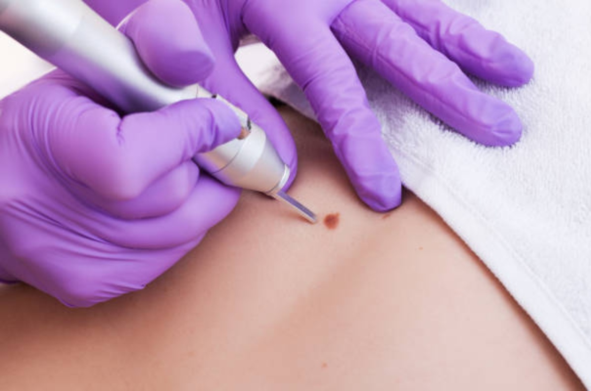 cómo eliminar verrugas del cuello