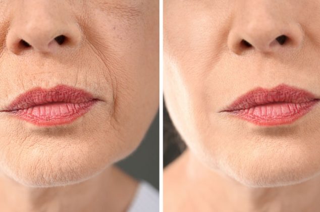 Con este remedio casero vas a eliminar las arrugas alrededor de la boca