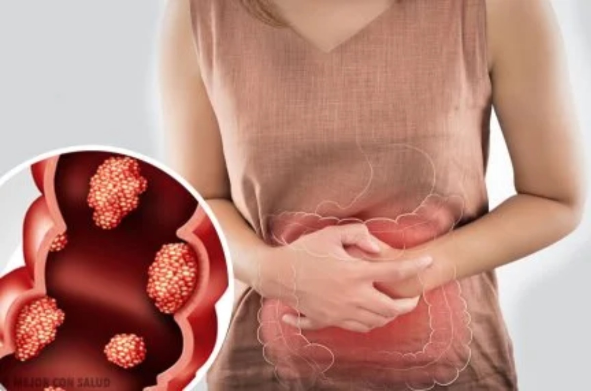 cáncer de colon
