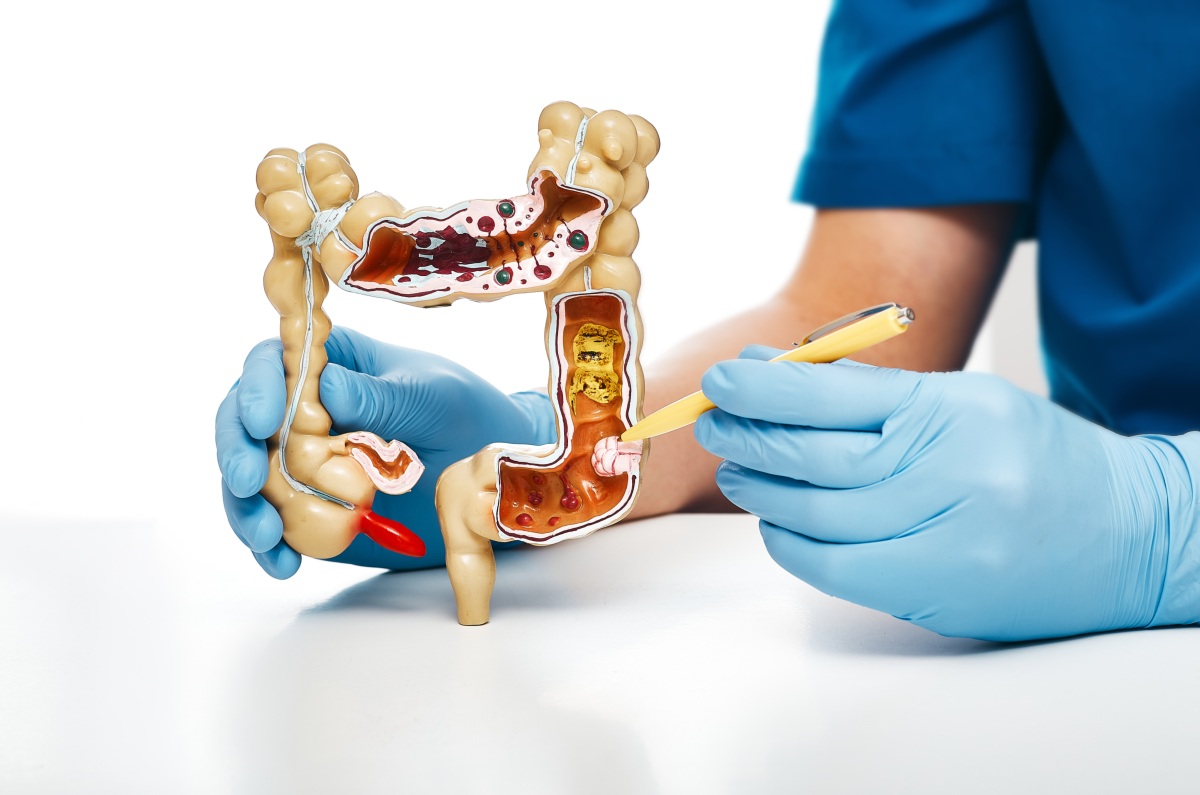 síntomas del cáncer de colon