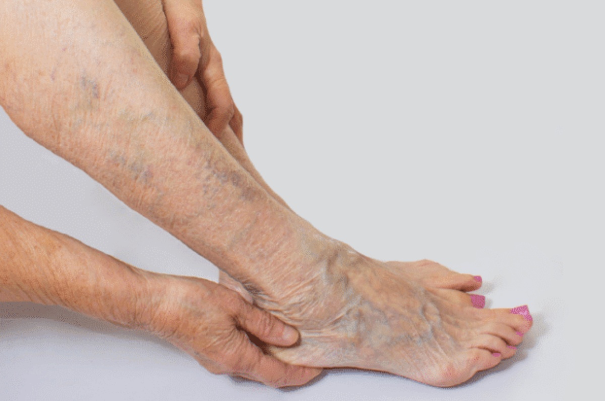planta para desinflamar las varices