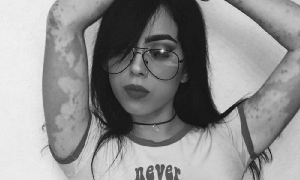 Qué es el vitiligo y qué lo causa