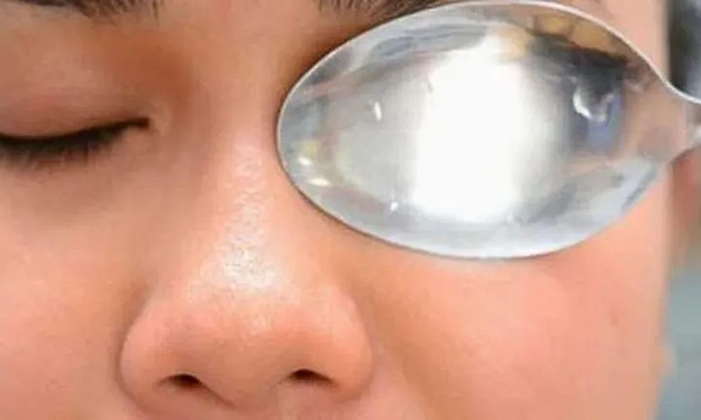 Cucharas en los ojos hinchados
