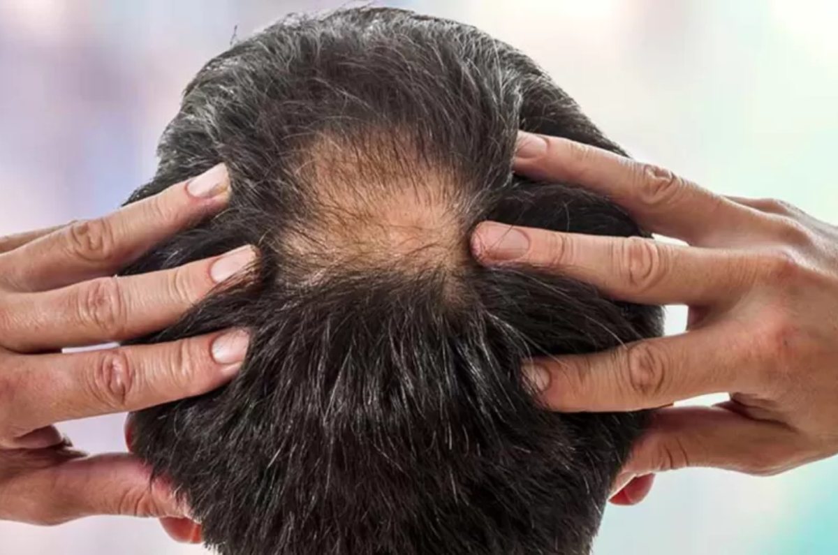 remedio casero para aliviar la calvicie